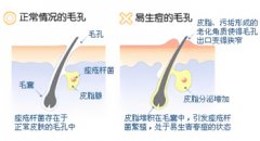 長春膚康醫(yī)院 青春痘