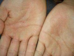 長春皮炎醫(yī)院