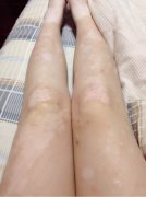長春白癜風(fēng)醫(yī)院