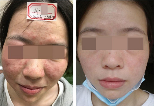 �L(zh��ng)����������֬����Ƥ��