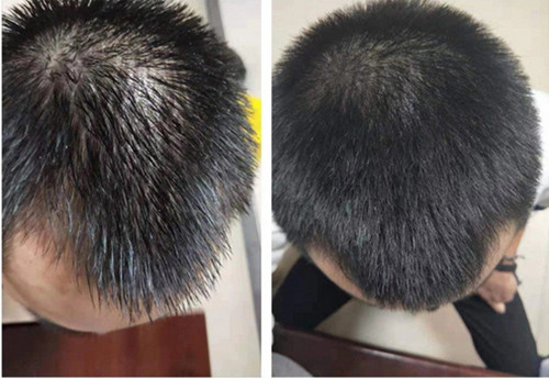 脂溢性脫發(fā)如何治療比較好