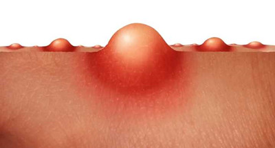 大腿內(nèi)側(cè)毛囊炎疙瘩怎么消除